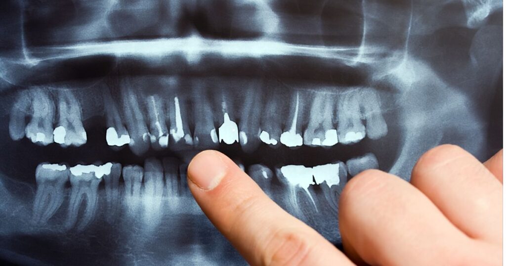 Meth Mouth Tooth Decay